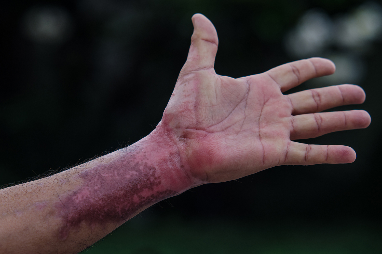 Columbia Araştırmacıları Yanık Hastaları İçin 3D Deri Biyobaskıladı