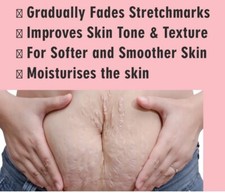 Stretch Mark Repair Cream - Postpartum Pregnancy Scar Remover & Skin Care Soluti Stretch Mark Prevention and Removal price