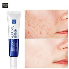 Face Skin Care Acne Treatment Removal Cream Spots Scar Blemish Marks Blemish Cream price