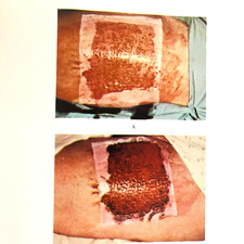 Vintage Burn Wound Covering Volume II Book Hardcover by Donald L. Wise 1984 Medical Books price