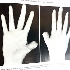 Vintage Mutilating Injuries of The Hand Mix Lot of 2 Books Hardcover 1979 Medical Books price