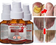 Supporto ANTIFUNGO FUNGO UNGHIE PIEDI EXTRA FORTE FUNGHI SP UNGHIE PIEDE ATLETA Cura Foot price