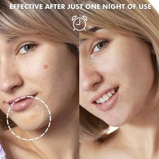 Grandi Cerotti Acne Brufoli per Viso, Mento, Schiena e Corpo 10 Conti, Punti Spot... Cura Acne e Pimple price