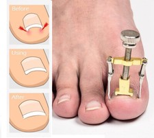 Ingrown Toenail Treatment Toe Clipper Pedicure Foot Care Correction Brace Tool Foot Verzorging price