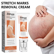 Stretch Marks Removal Cream – Pregnancy Belly Repair & Scar/Spot Remover Stretch Mark Prevention and Removal price