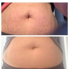 Stretch Mark Reducer Cream for Abdomen 1 Stretch Mark Prevention and Removal price