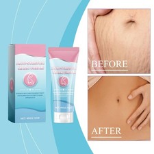 Anti Stretch Marks Cream Repairs Moisturizes Postpartum Skin Reduces Fine Lines Postpartum Stretch Mark Cream price