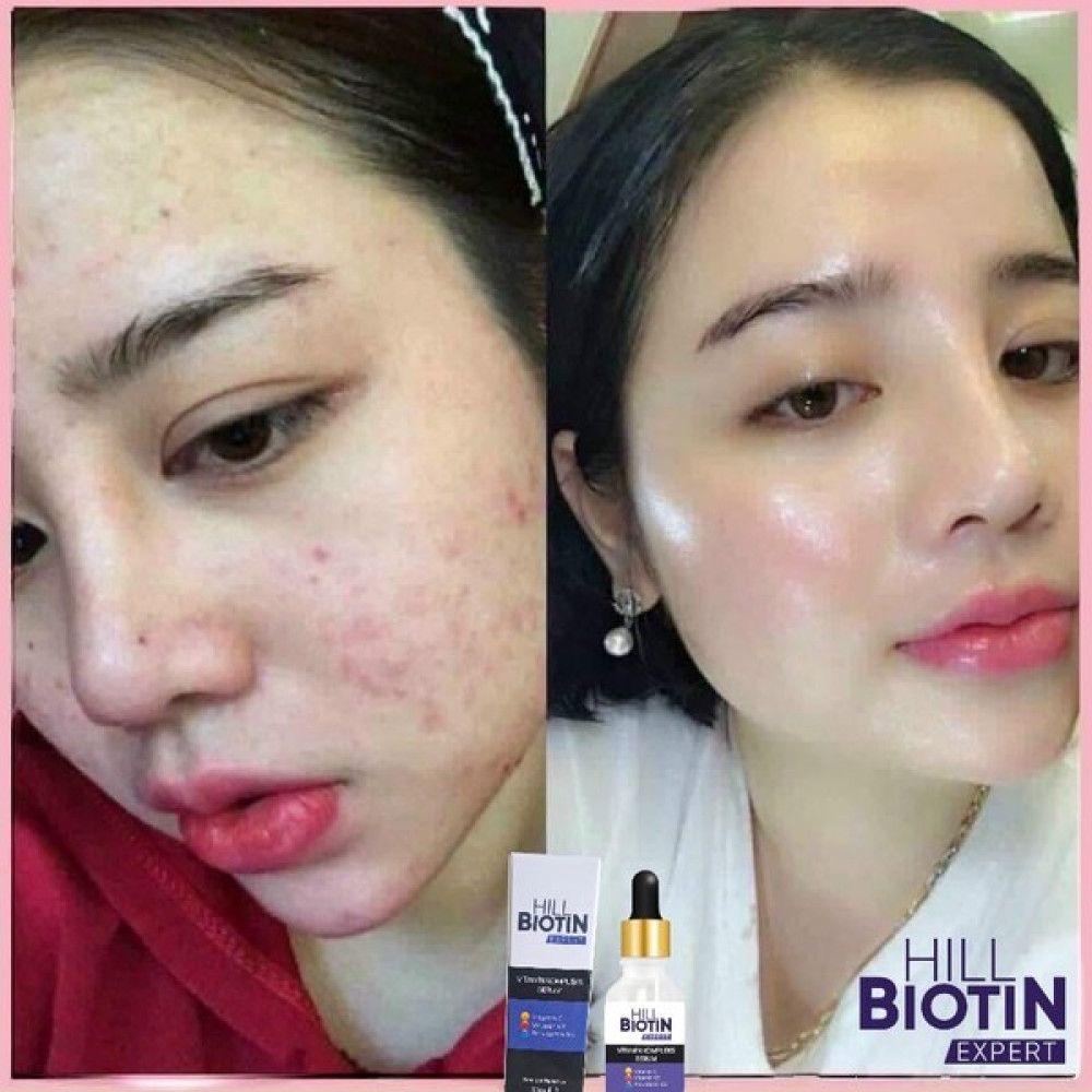Hill Biotin Expert C Vitamini Leke Karşıtı & aydınlatıcı,sivilce karşıtı,yüz ve gözenek sıkılaştırıcı,Serum 30ml Anti-Aging / Yaşlanma Karşıtı Fiyatı