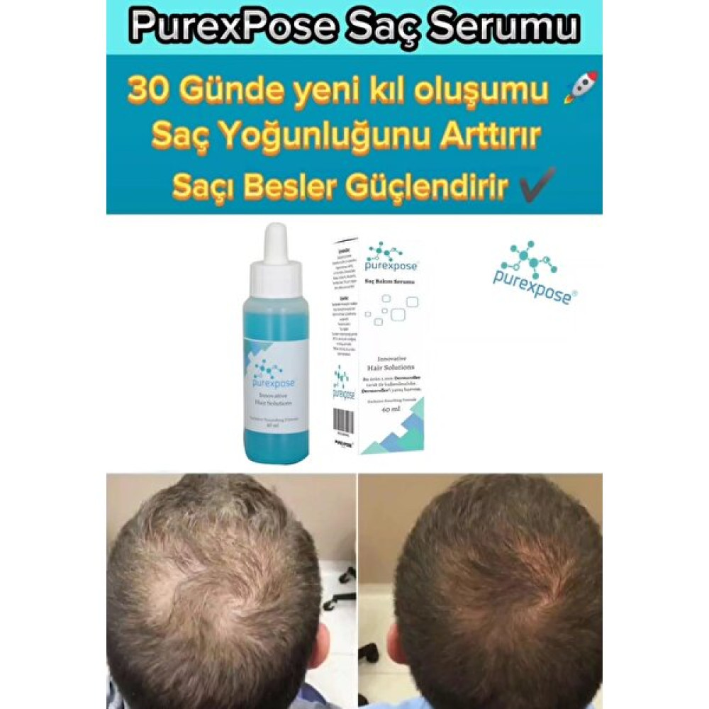 Purexpose Saç Bakım Serumu & Saç Çıkarıcı Losyon BAY/BAYAN 1ADET - Açık Mavi Saç Bakım Maskeleri & Serumlar & Spreyler Fiyatı